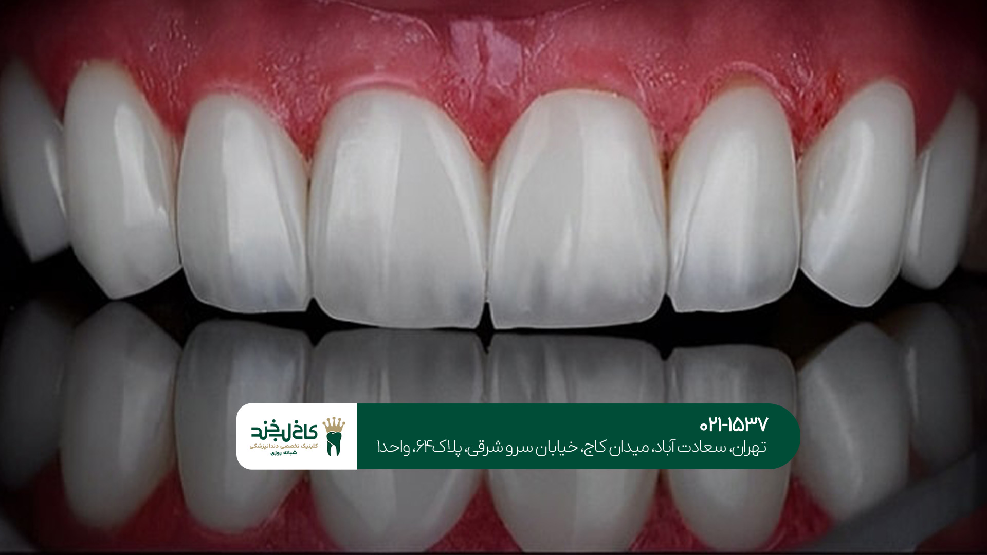 کامپوزیت و لمینت اقساطی کامپوزیت و لمینت اقساطی