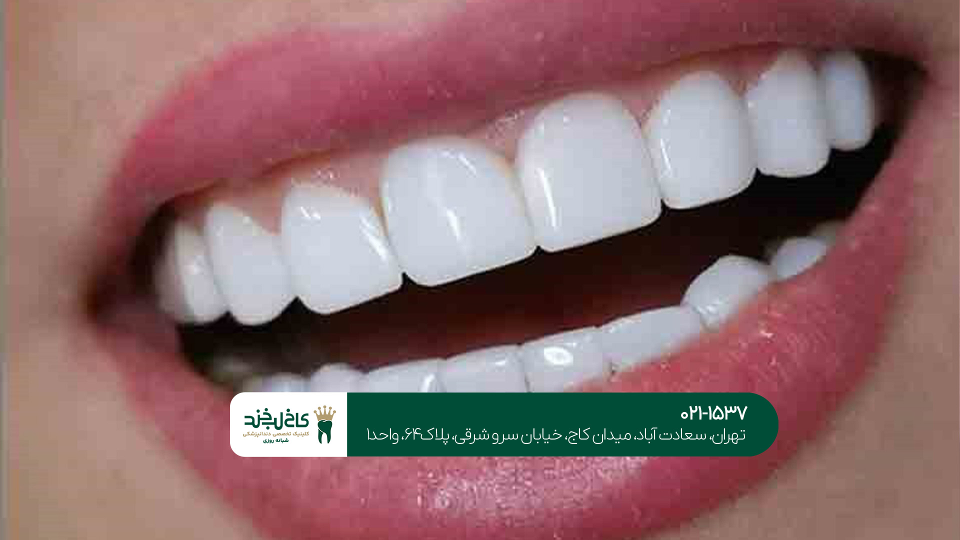 کامپوزیت و لمینت اقساطی کامپوزیت و لمینت اقساطی