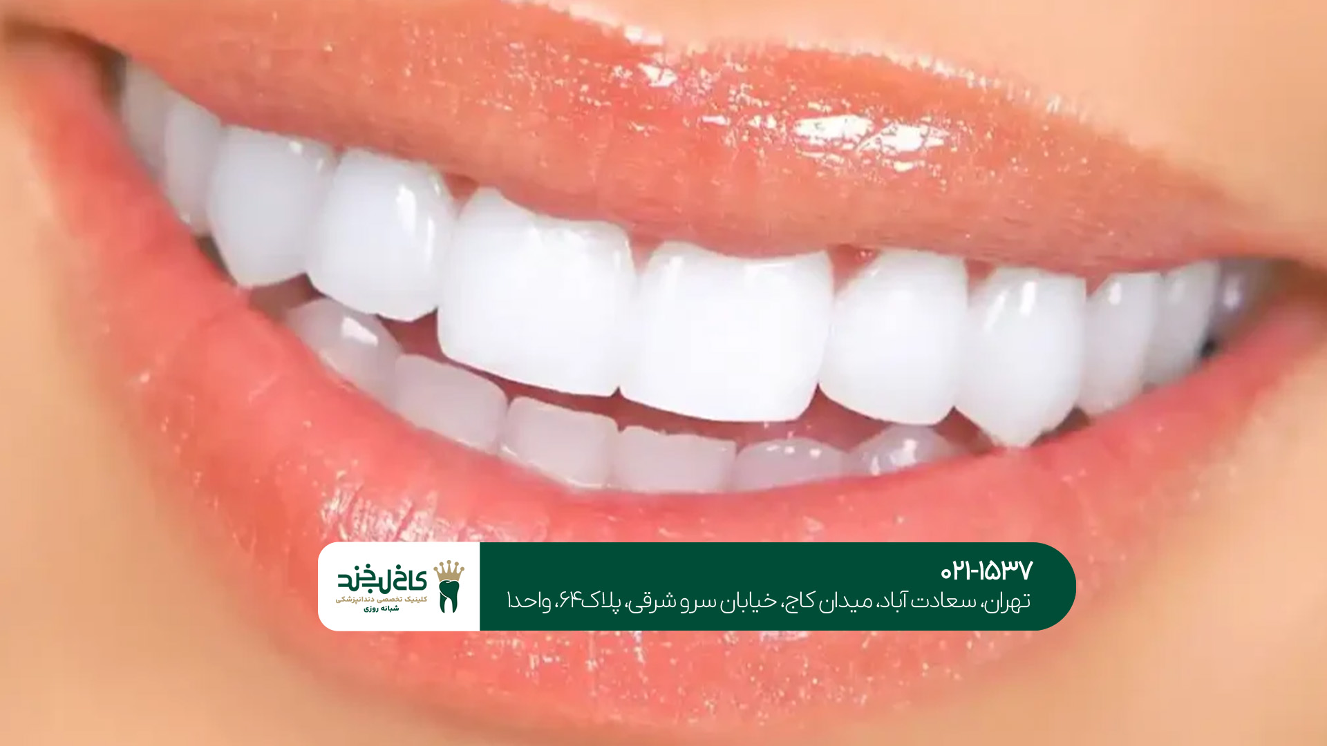 کامپوزیت و لمینت اقساطی