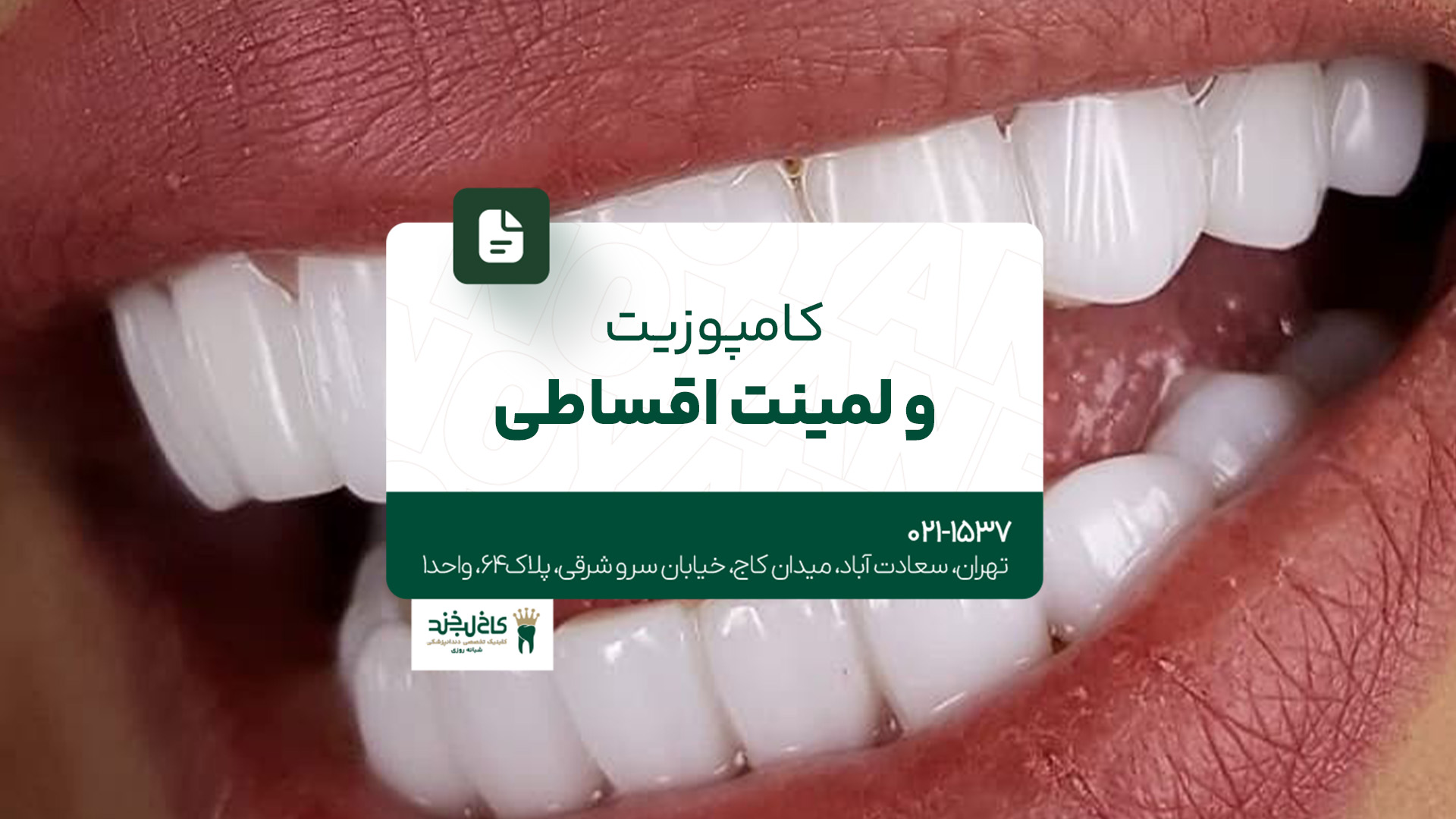کامپوزیت و لمینت اقساطی کامپوزیت و لمینت اقساطی