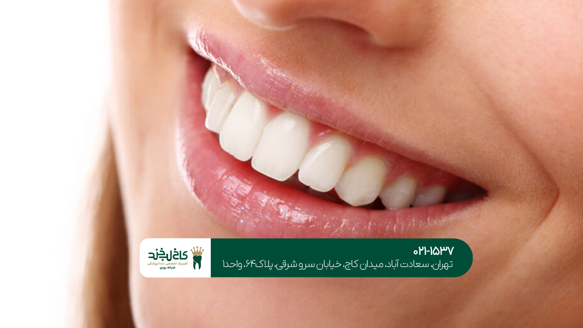 کامپوزیت ونیر کامپوزیت ونیر