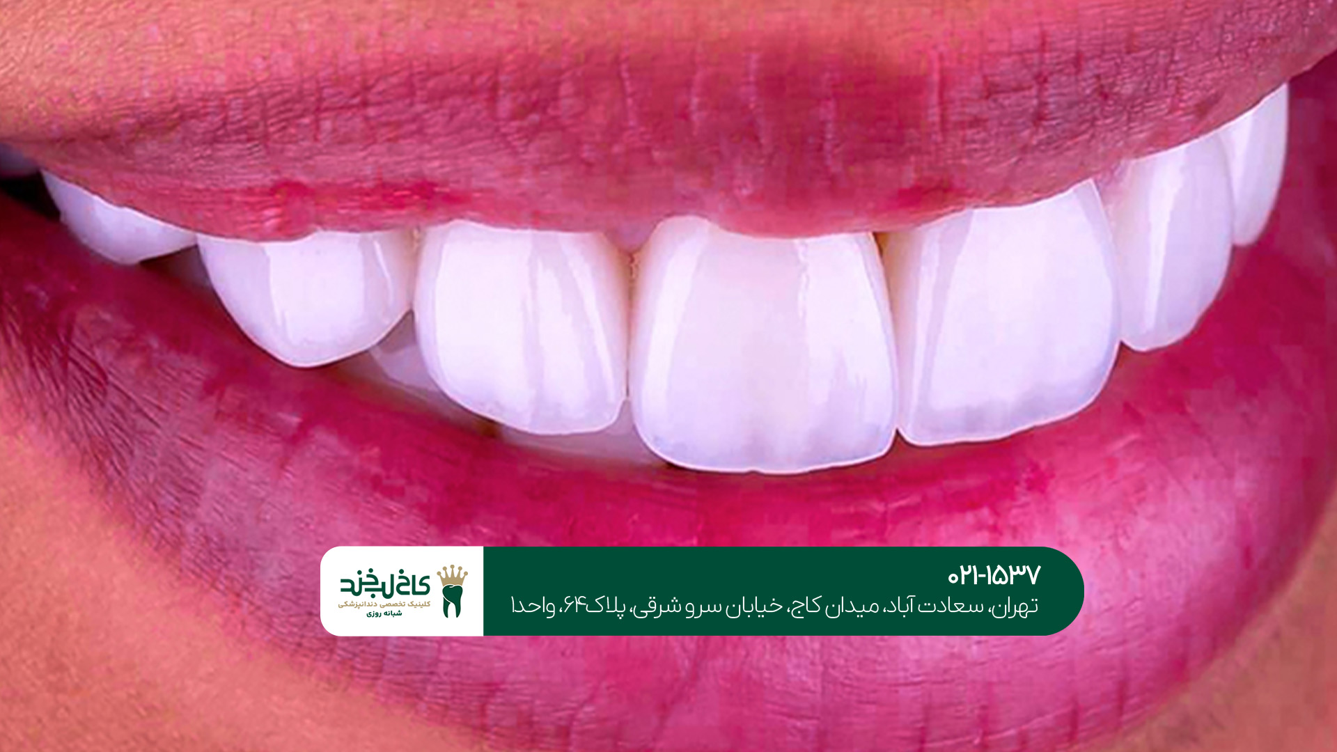 کامپوزیت ونیر تهران کامپوزیت ونیر تهران