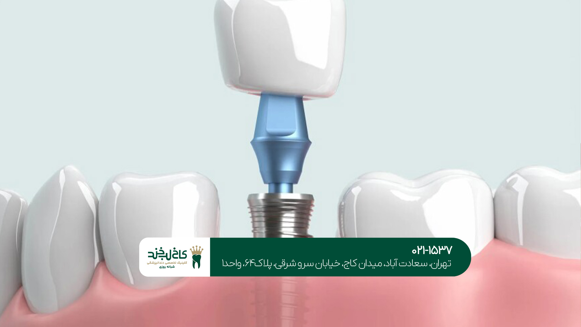 کلینیک تخصصی ایمپلنت دیجیتال در تهران