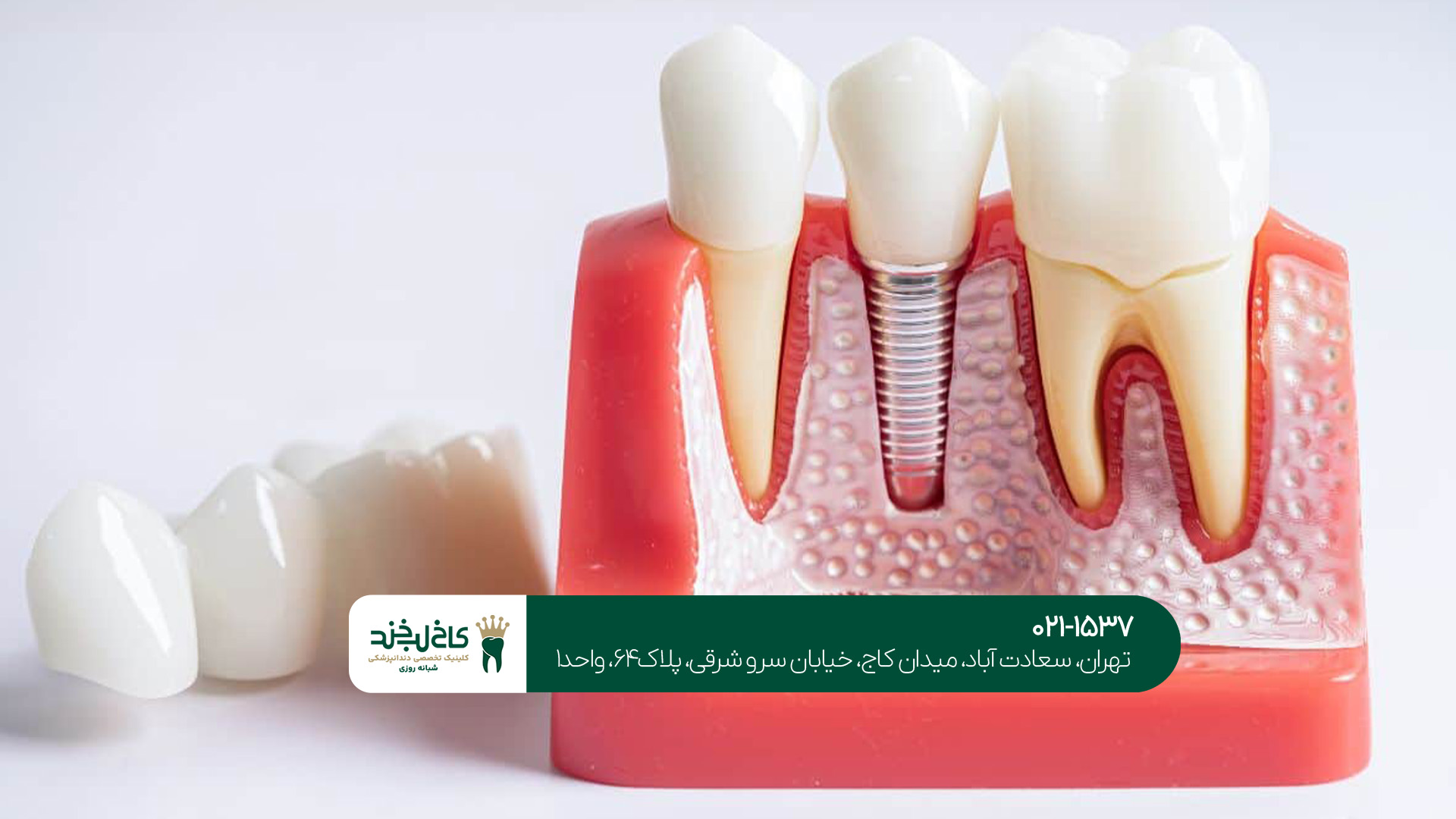 کلینیک تخصصی ایمپلنت دیجیتال در تهران