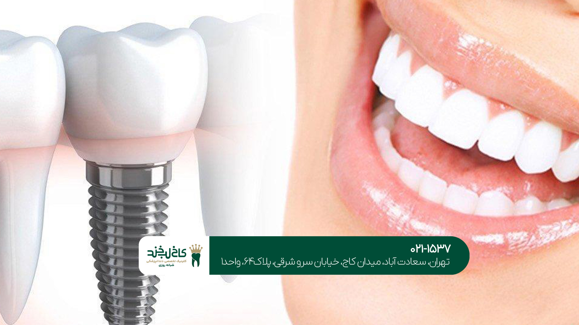 کلینیک تخصصی ایمپلنت دیجیتال در تهران