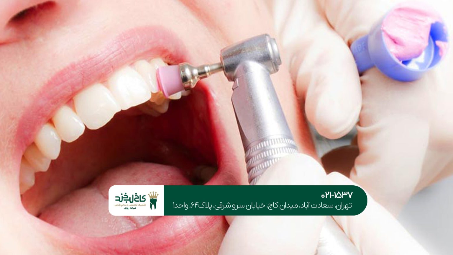 جرم گیری در دندانپزشکی تخصصی+4 مزایای جرمگیری در کاخ لبخند