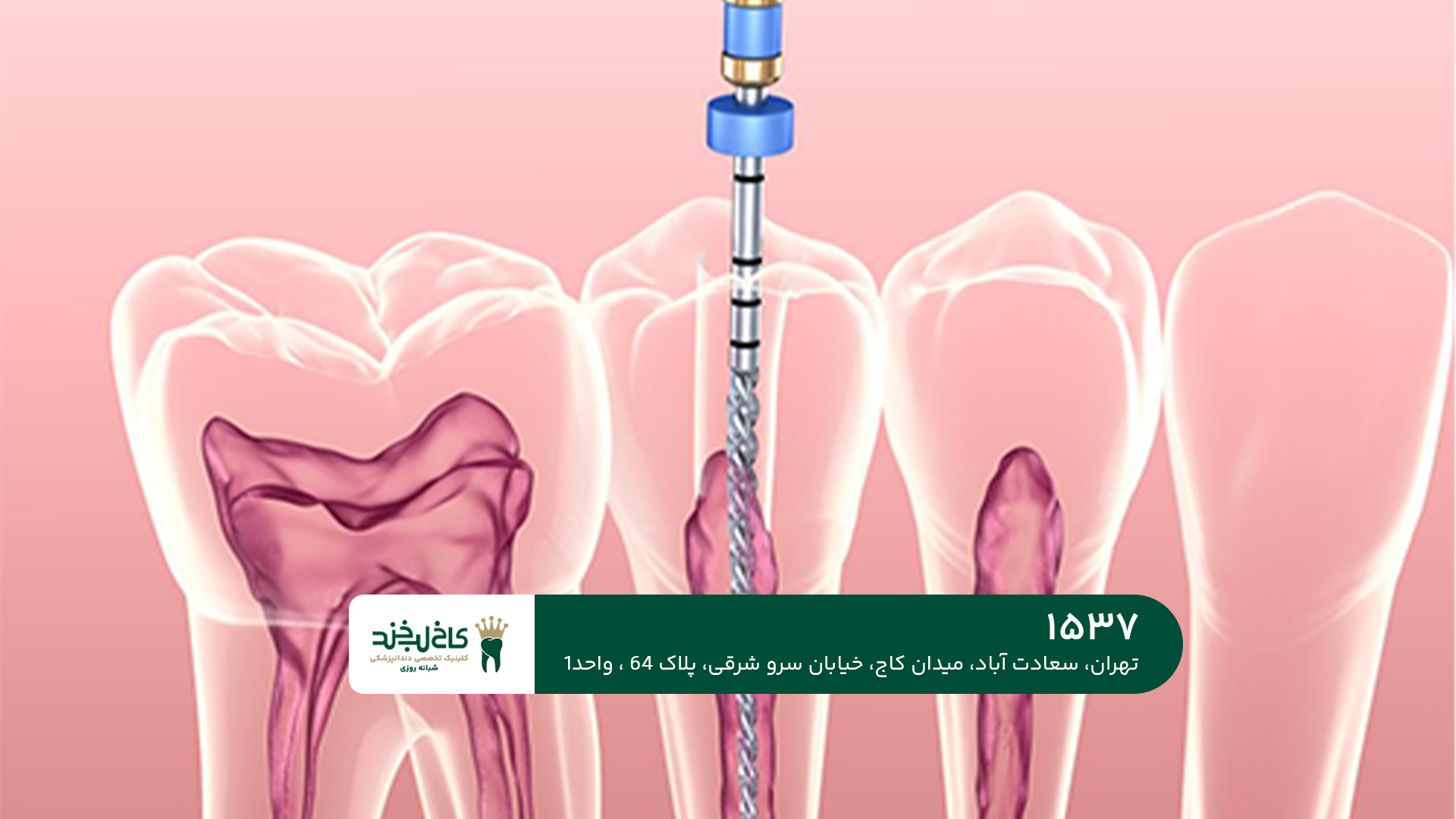 عصب کشی عصب کشی