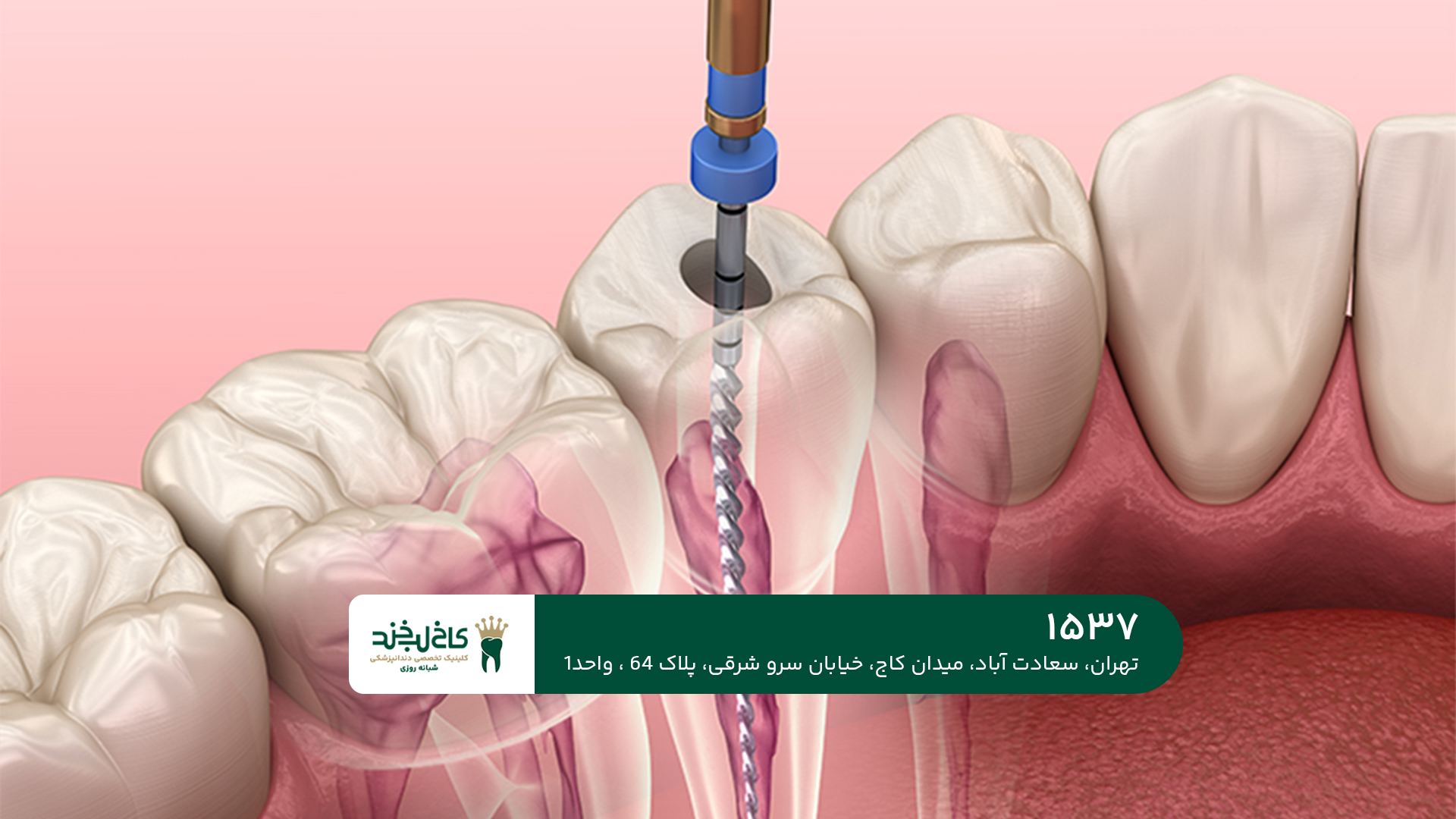 عصب کشی دندان عصب کشی دندان