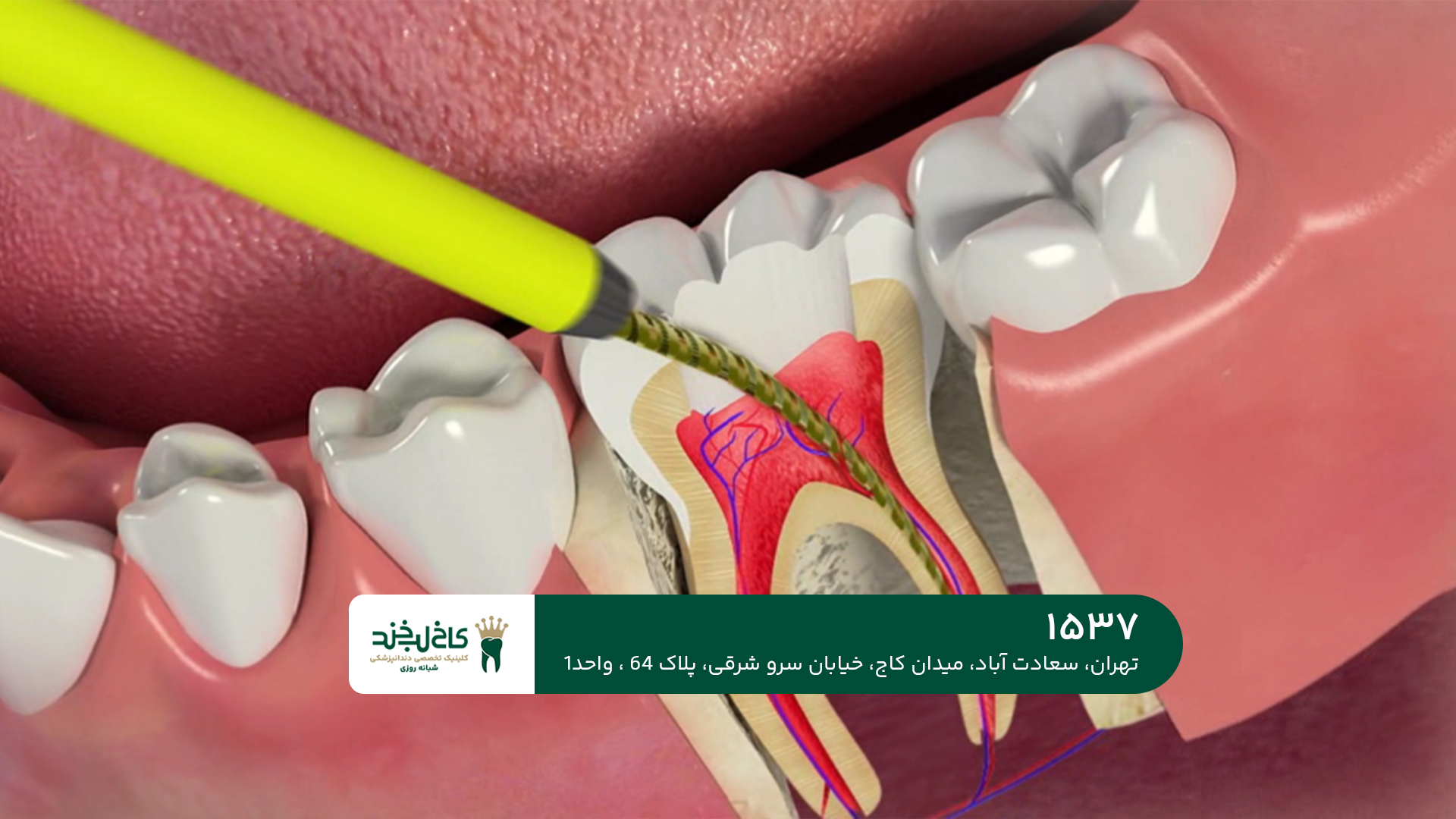 عصب کشی دندان عصب کشی دندان