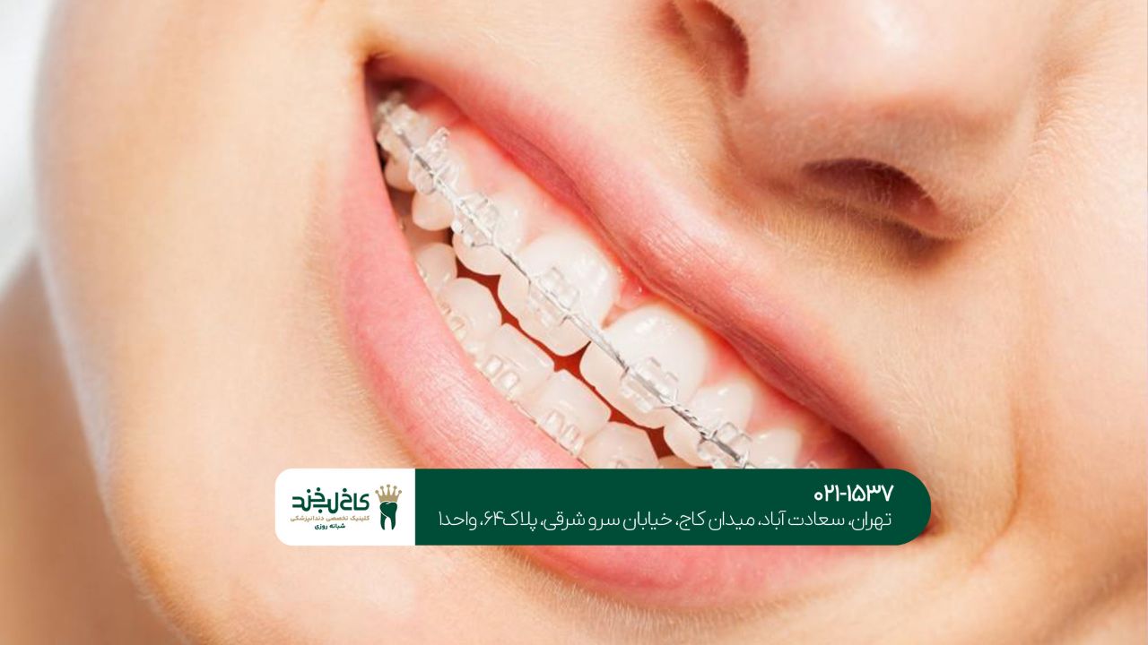 ارتودنسی نامرئی تهران ارتودنسی نامرئی تهران
