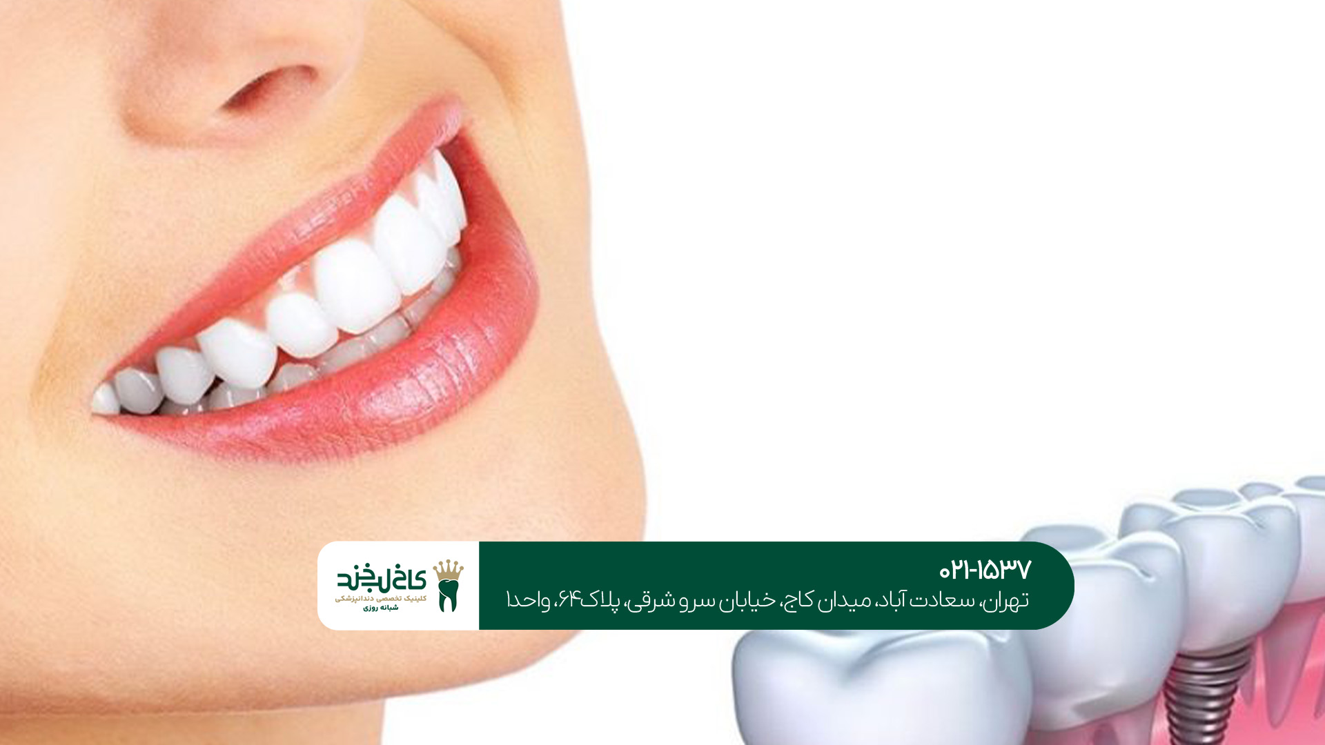 ایمپلنت دندان به صورت دیجیتال ایمپلنت دندان به صورت دیجیتال