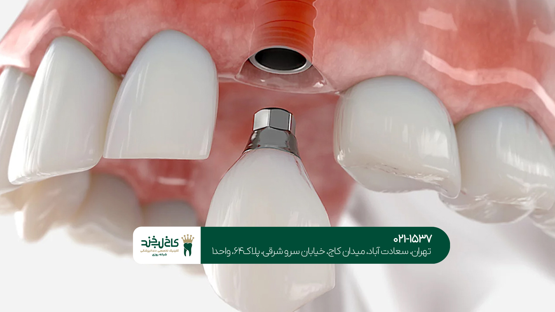 ایمپلنت دندان به صورت دیجیتال ایمپلنت دندان به صورت دیجیتال