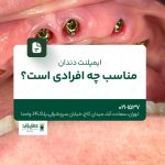 ایمپلنت دندان مناسب چه افرادی است؟