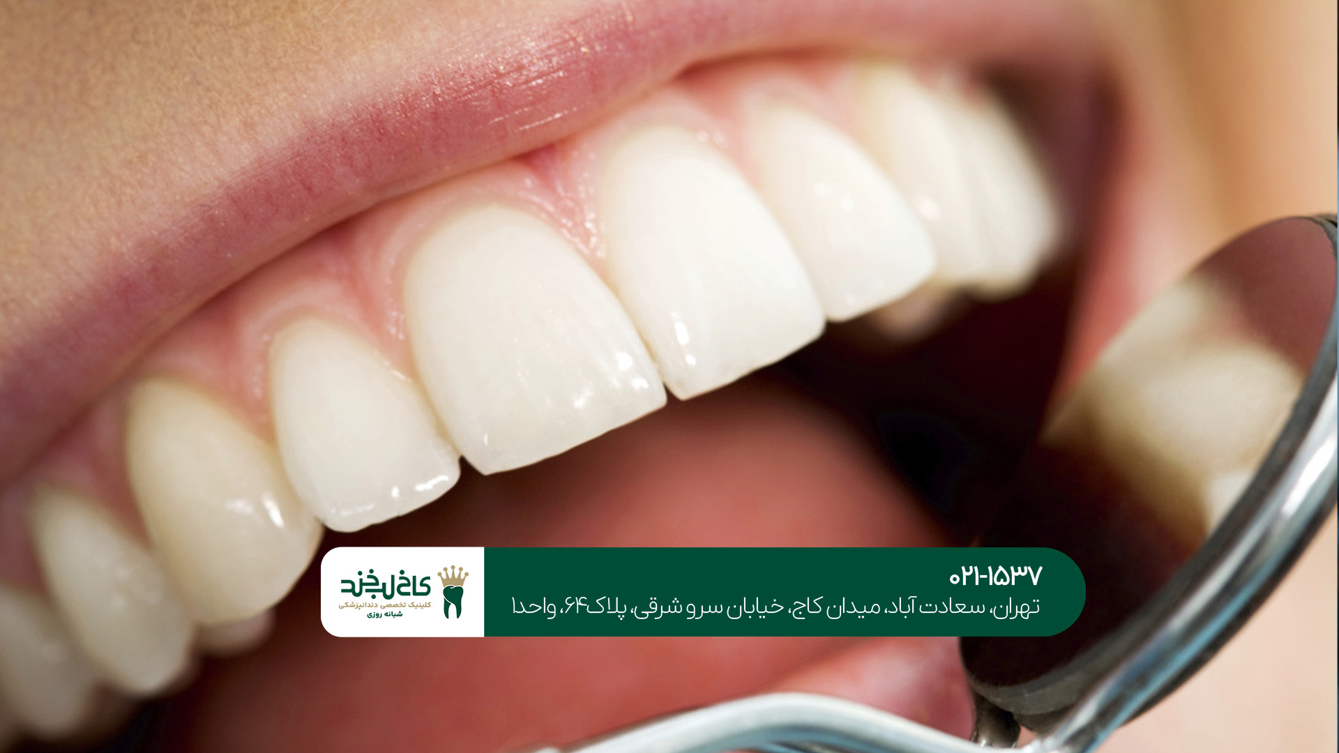 بهترین روش های زیبایی دندان بهترین روش های زیبایی دندان