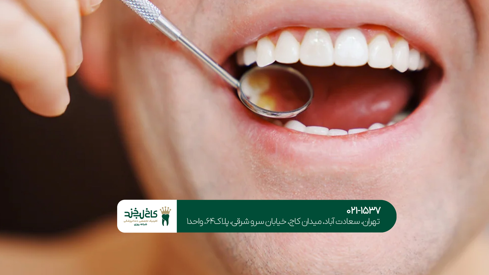 بهترین روش های زیبایی دندان بهترین روش های زیبایی دندان