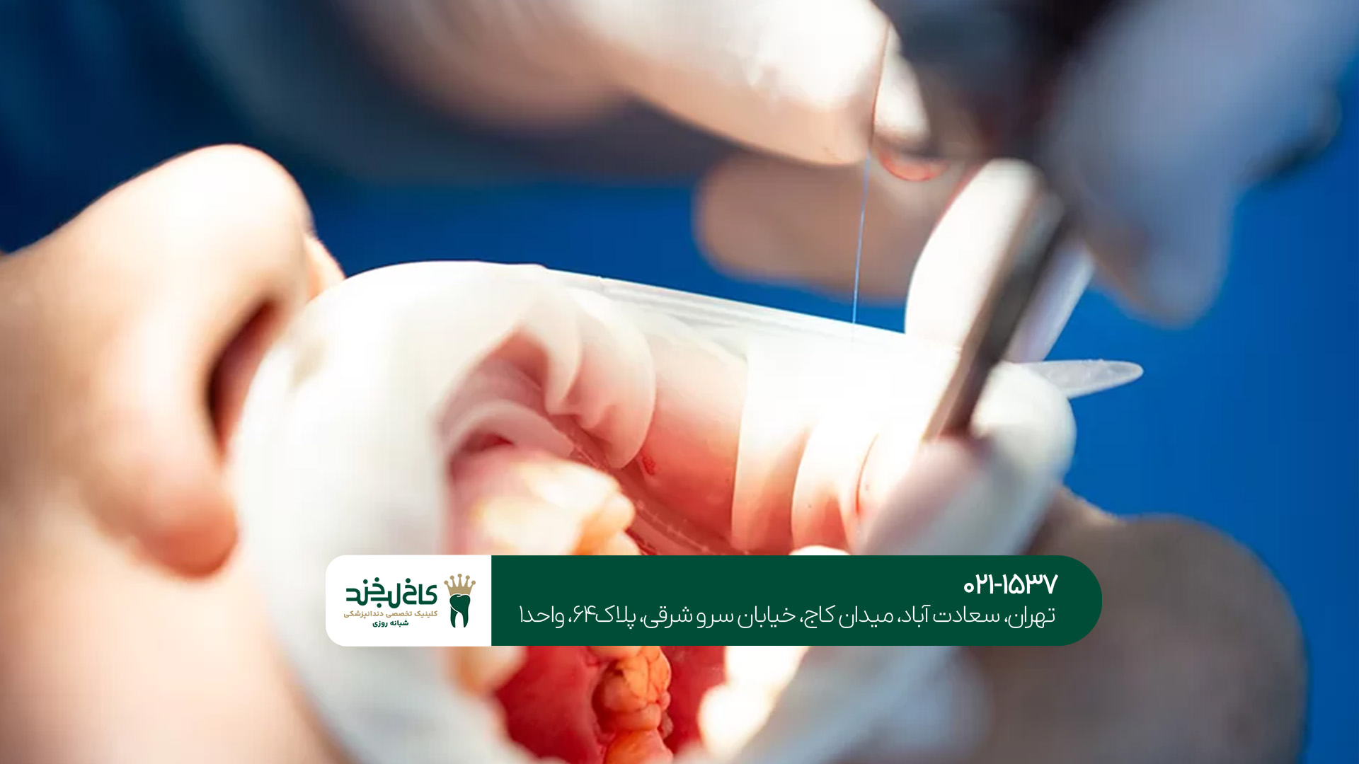 ترمیم و کشیدن دندان در تهران