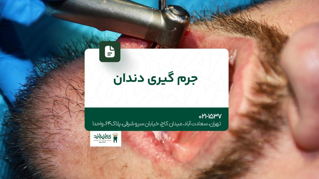 جرم گیری دندان