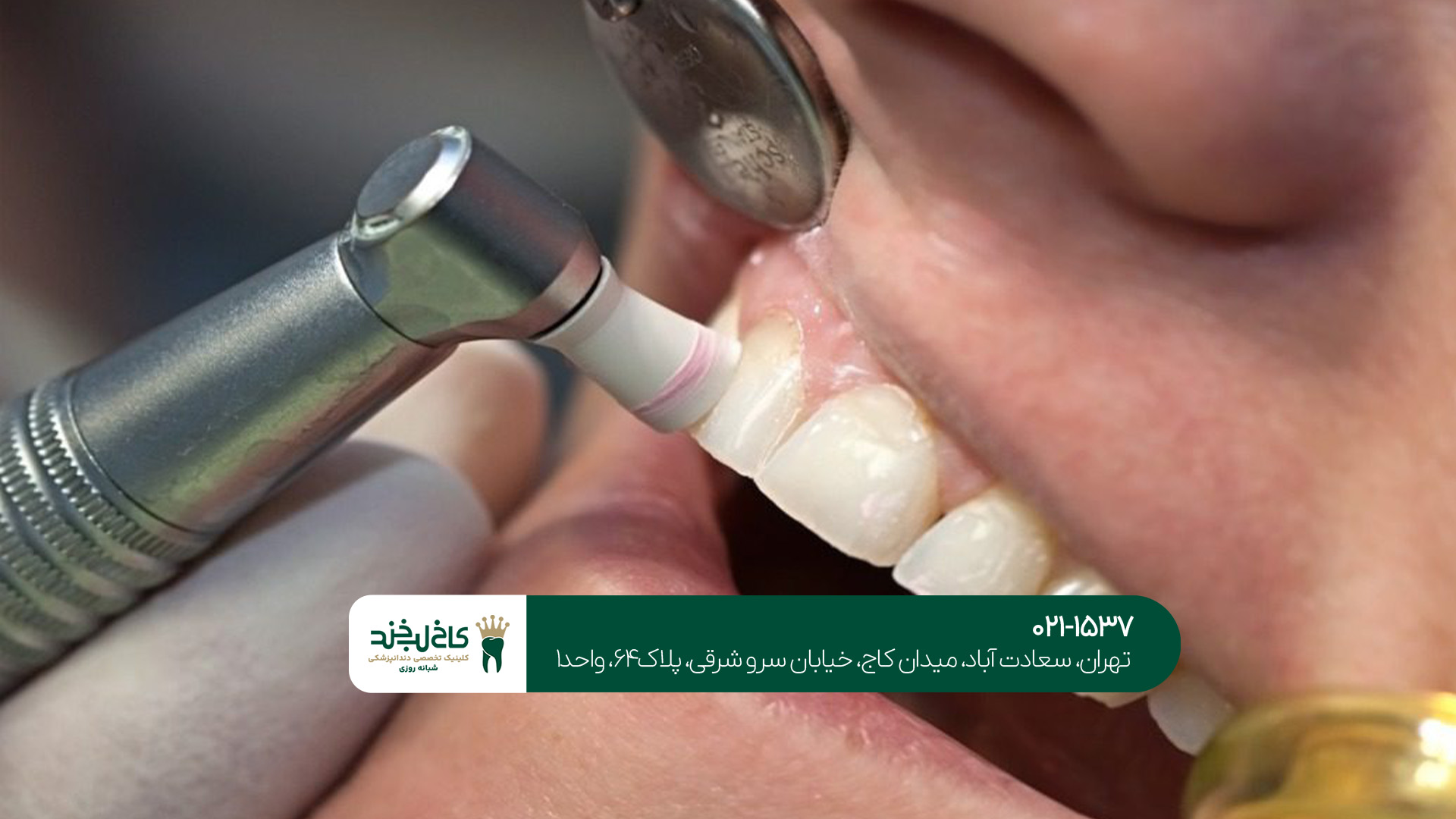 جرم گیری دندان در مرکز تخصصی جرم گیری دندان در مرکز تخصصی