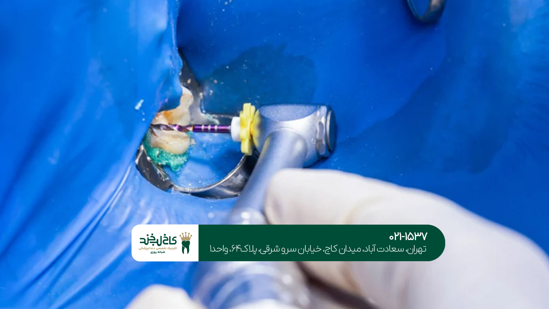 درمان ریشه دندان در شمال تهران درمان ریشه دندان در شمال تهران