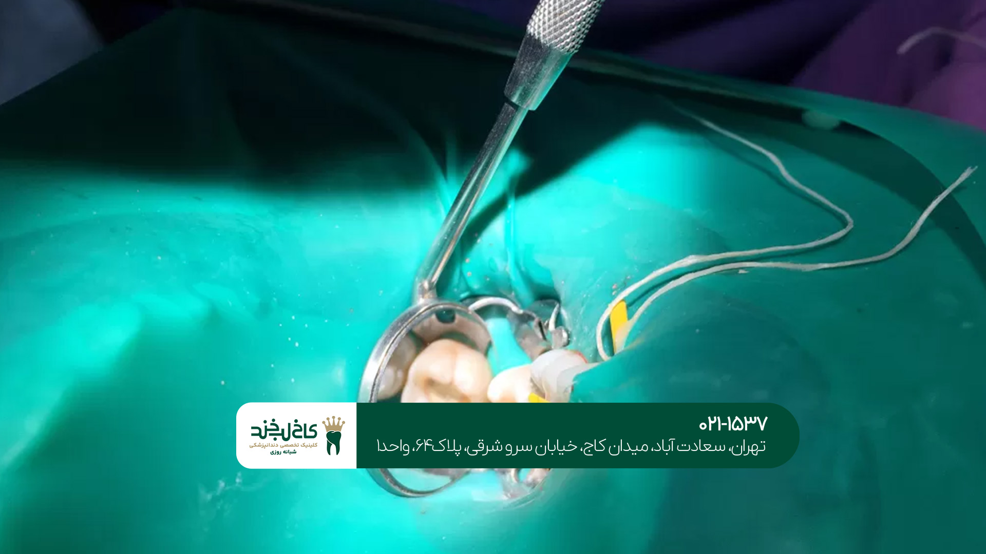 درمان ریشه دندان در شمال تهران درمان ریشه دندان در شمال تهران