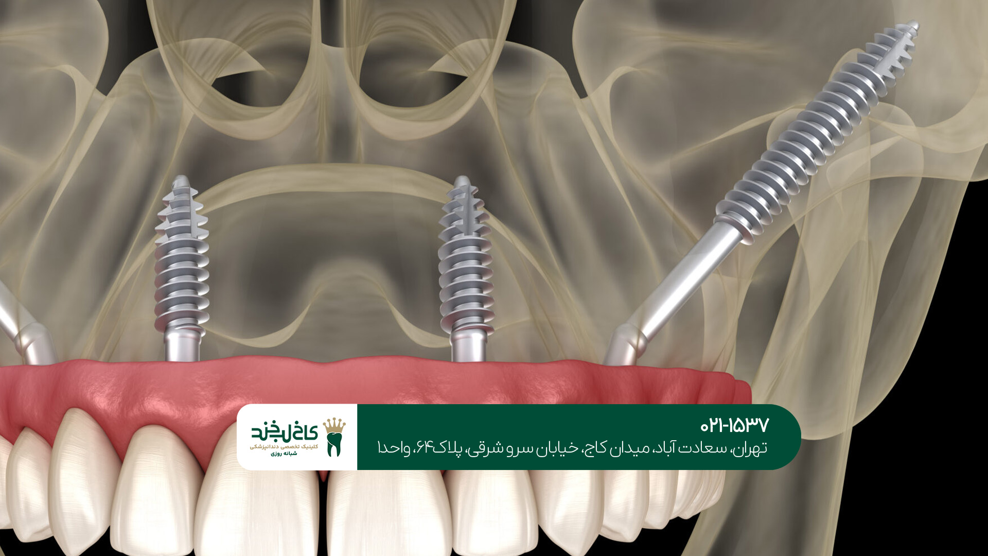 دندانپزشک متخصص ایمپلنت دیجیتال