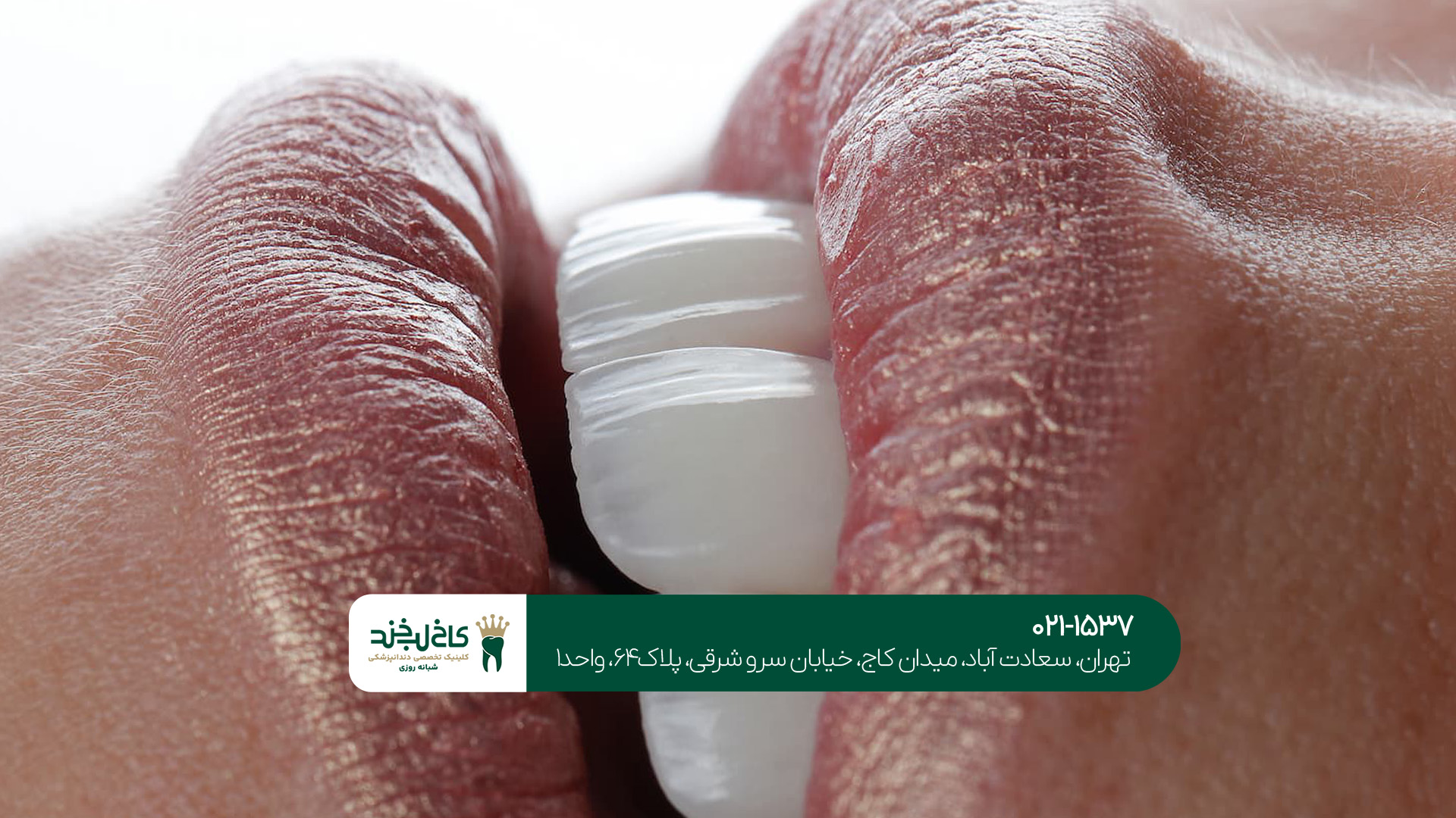 دندانپزشکی زیبایی و خدمات آن دندانپزشکی زیبایی و خدمات آن