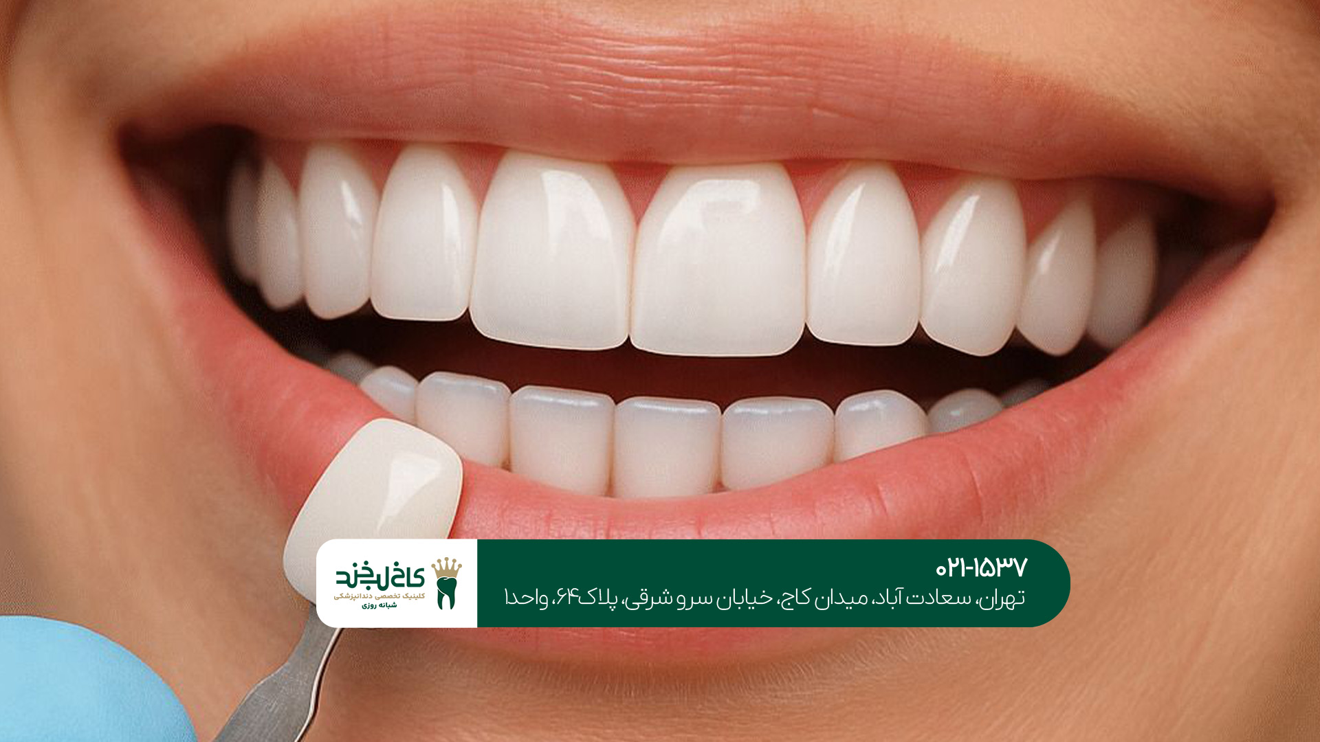 دندانپزشکی اقساطی لمینت و ایمپلنت دندانپزشکی اقساطی لمینت و ایمپلنت