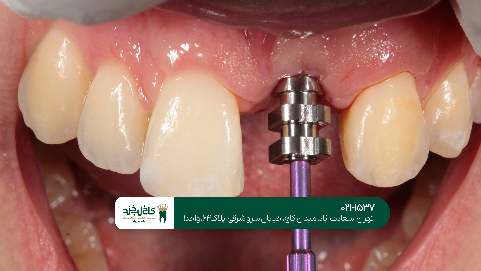دندانپزشکی اقساطی لمینت و ایمپلنت دندانپزشکی اقساطی لمینت و ایمپلنت