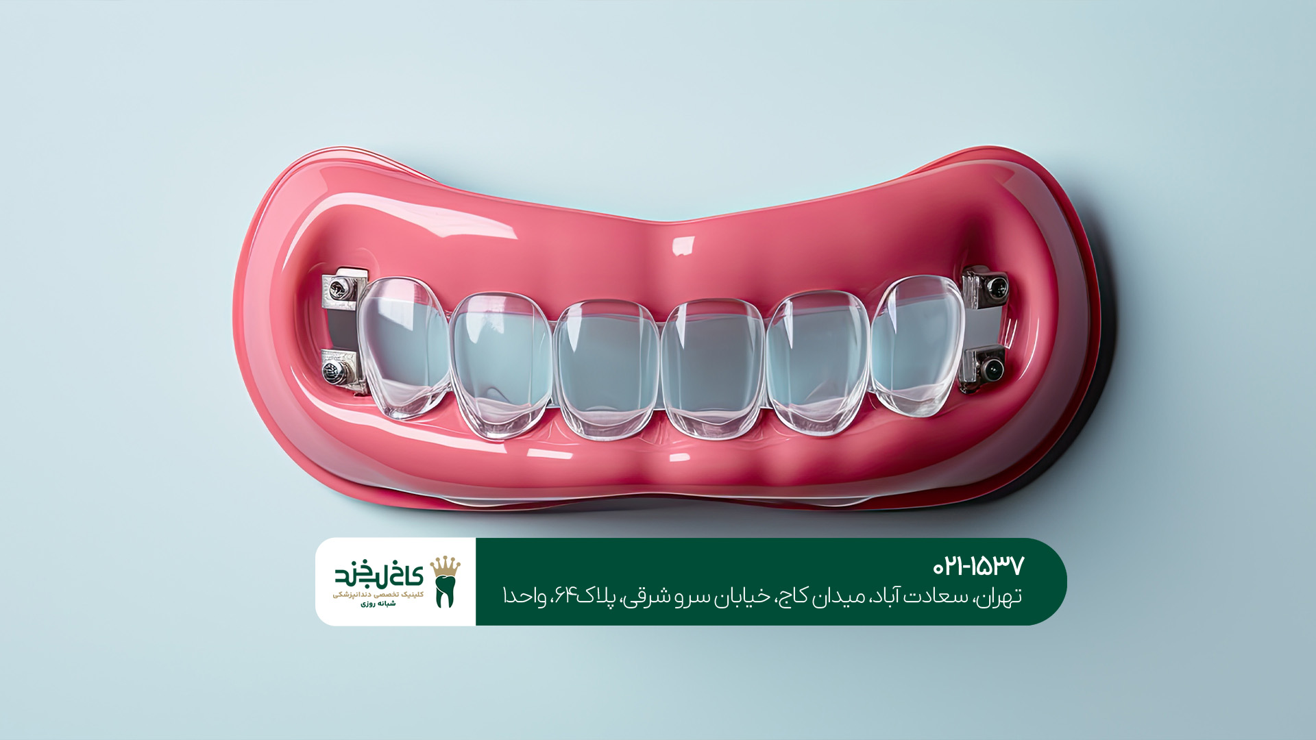 دندانپزشکی اقساطی لمینت و ایمپلنت دندانپزشکی اقساطی لمینت و ایمپلنت