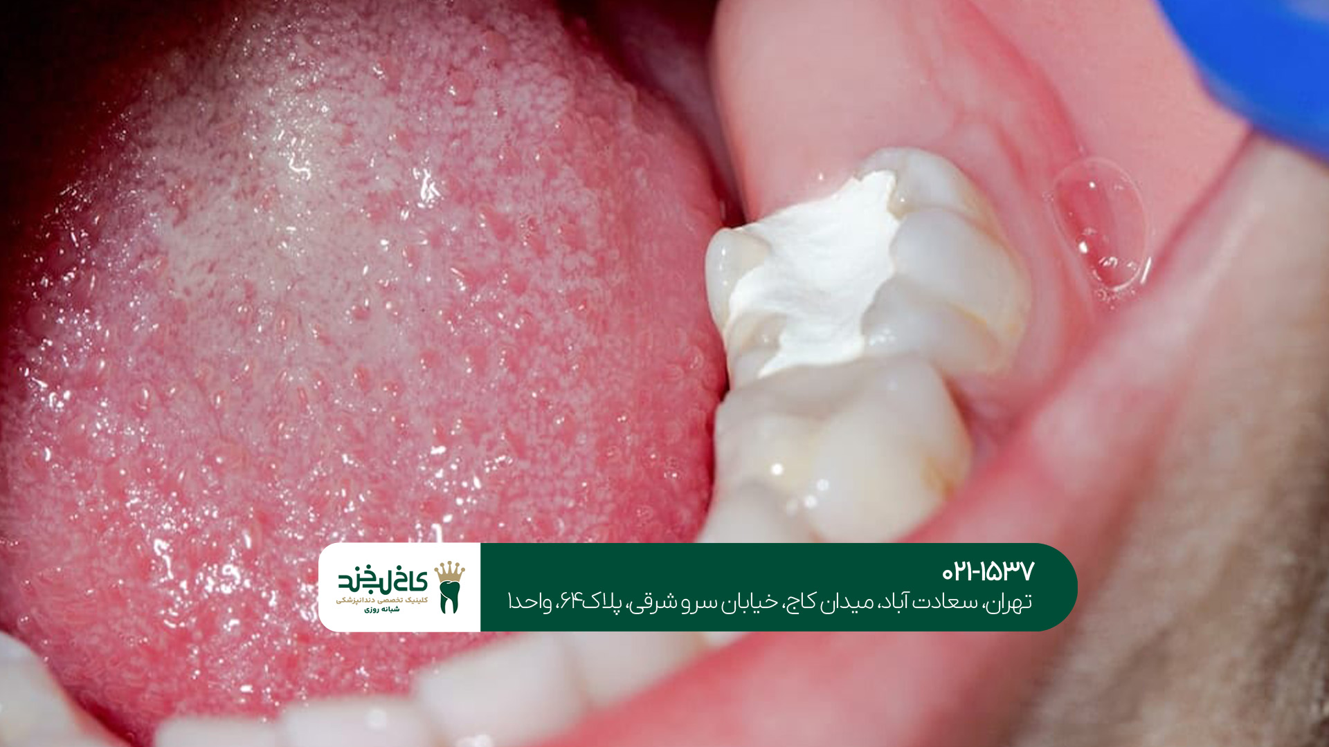 بهترین مرکز تخصصی عصب کشی بهترین مرکز تخصصی عصب کشی