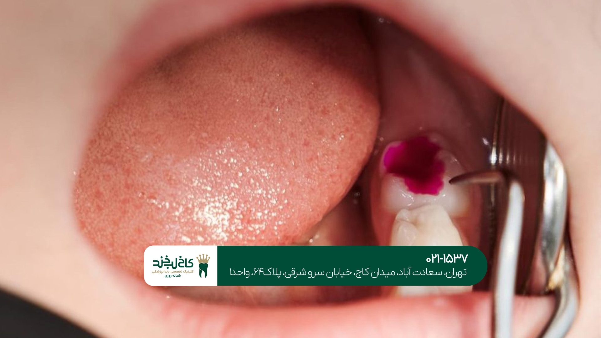 عصب کشی دندان تهران عصب کشی دندان تهران