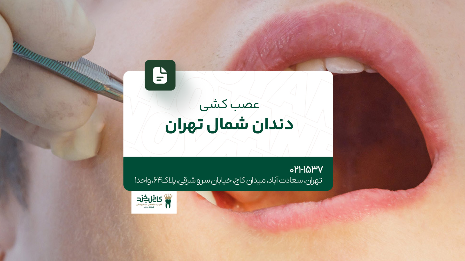 عصب کشی دندان شمال تهران عصب کشی دندان شمال تهران