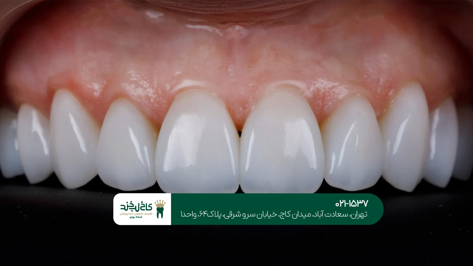 مراحل لمینت تخصصی دندان