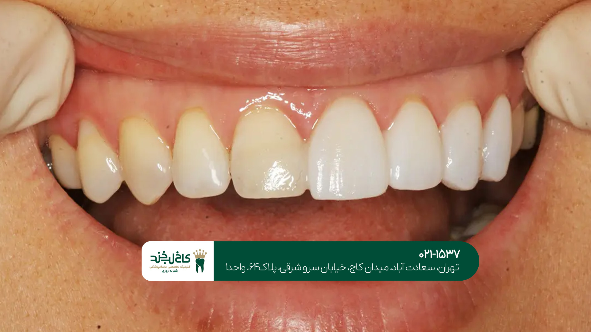 لمینت دندان تهران