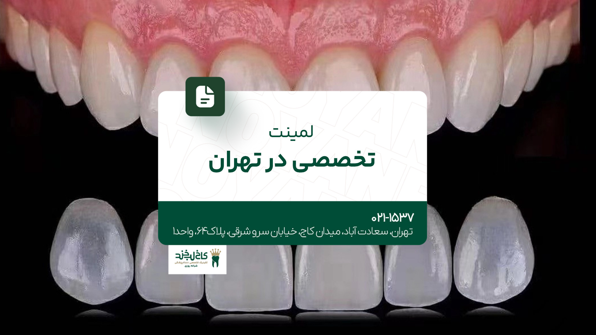 لمینت تخصصی در تهران