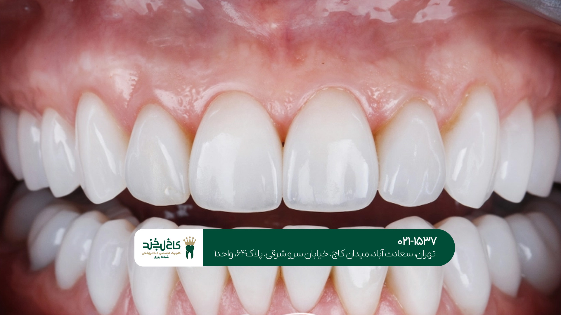  لمینت دندان اقساطی تهران