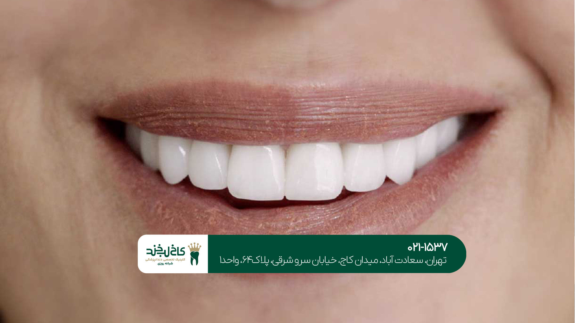  لمینت دندان اقساطی تهران