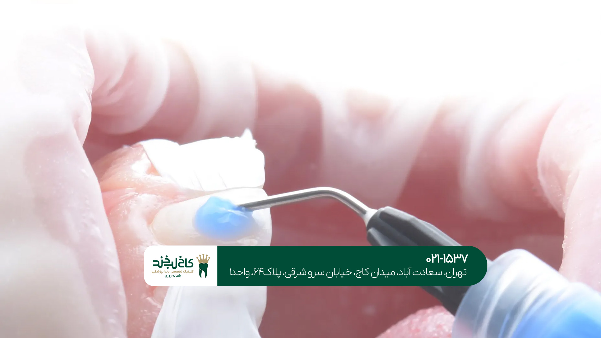 مزایای کامپوزیت ونیر