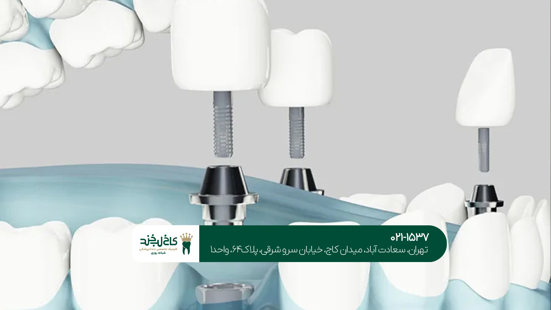 مرکز تخصصی ایمپلنت دیجیتال تهران مرکز تخصصی ایمپلنت دیجیتال تهران