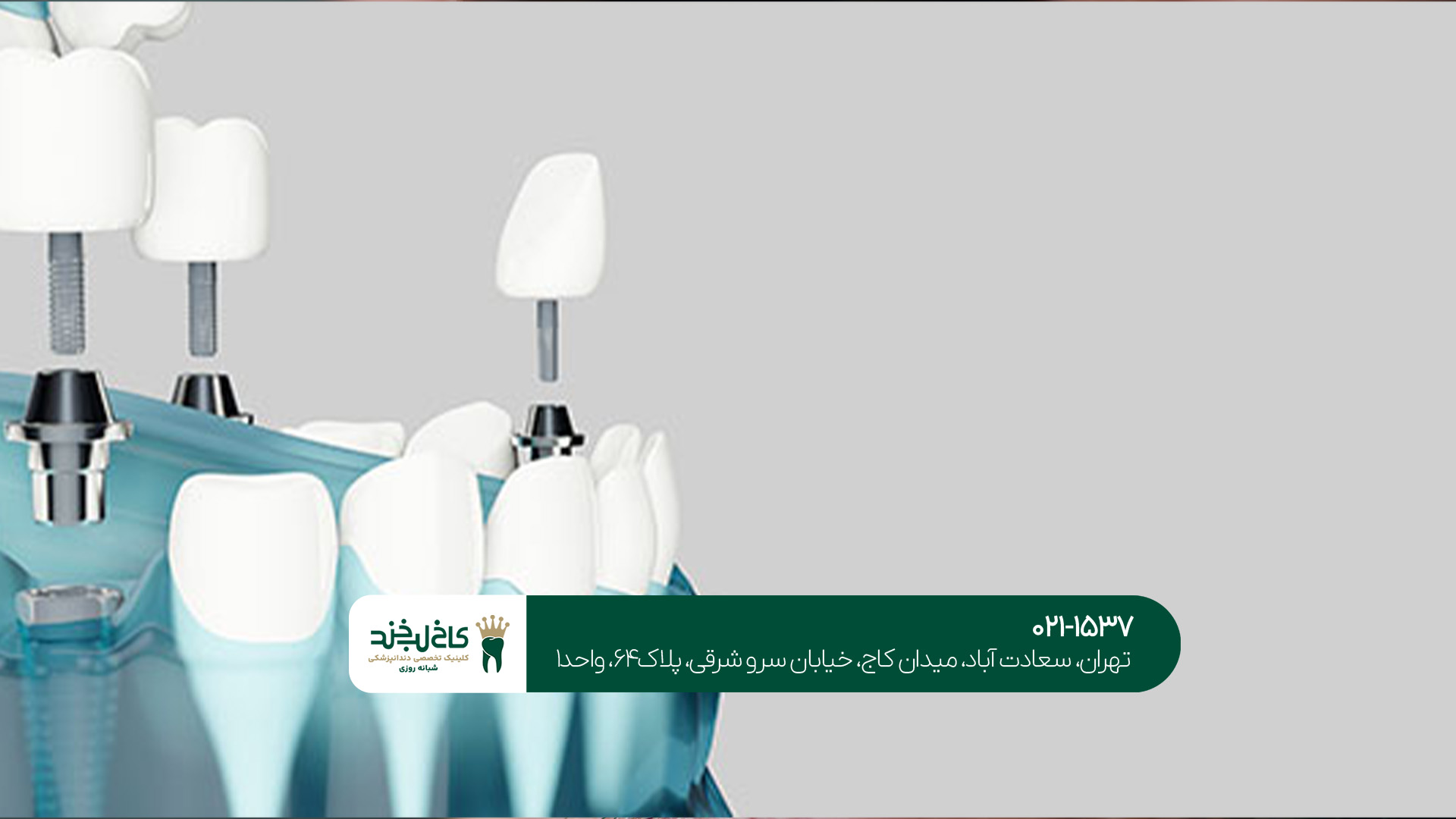 مرکز تخصصی ایمپلنت دیجیتال تهران مرکز تخصصی ایمپلنت دیجیتال تهران