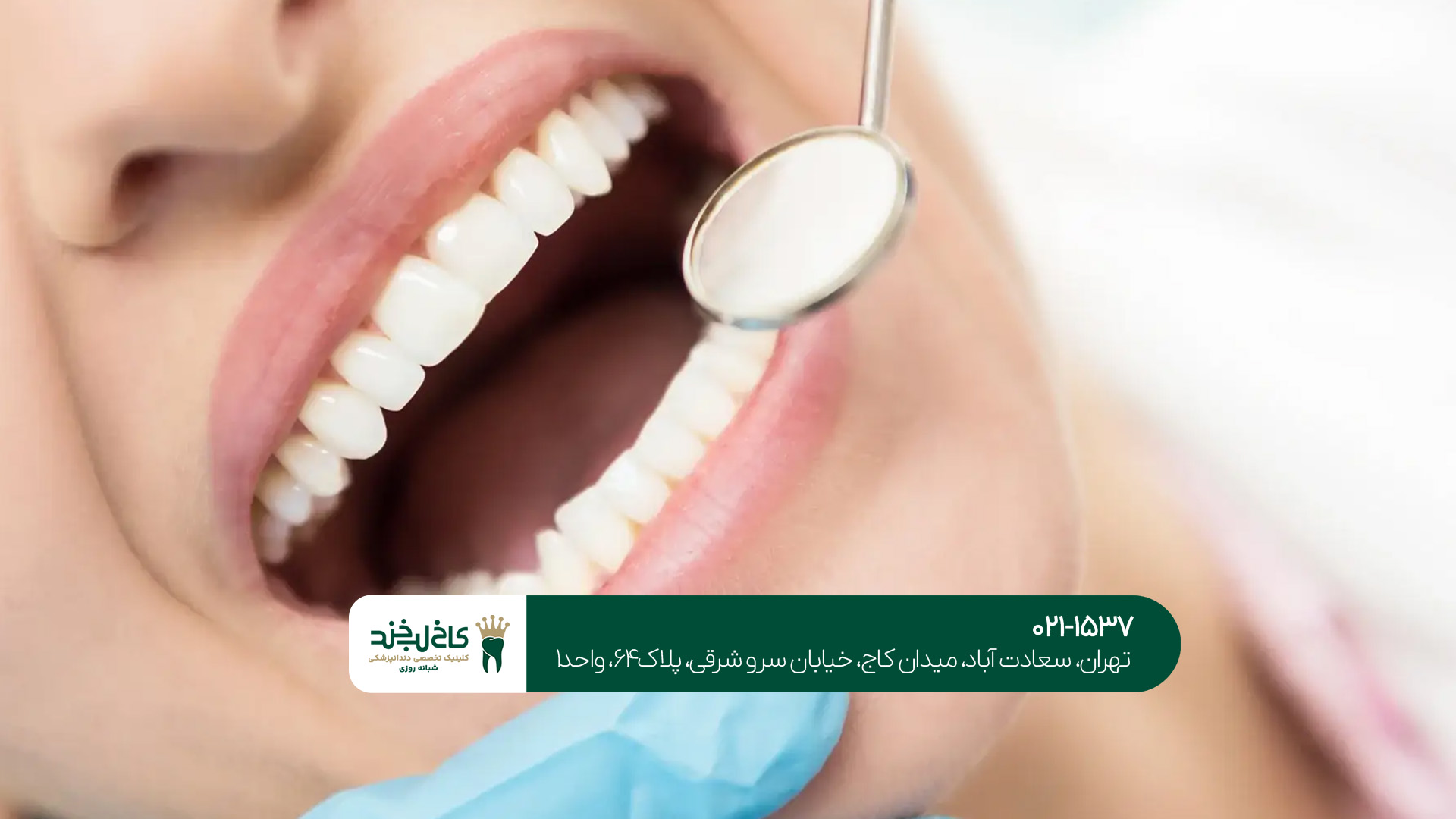 کامپوزیت دندان جنوب تهران کامپوزیت دندان جنوب تهران