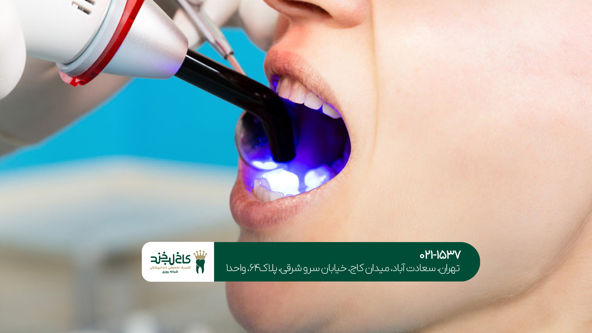 کامپوزیت دندان جنوب تهران