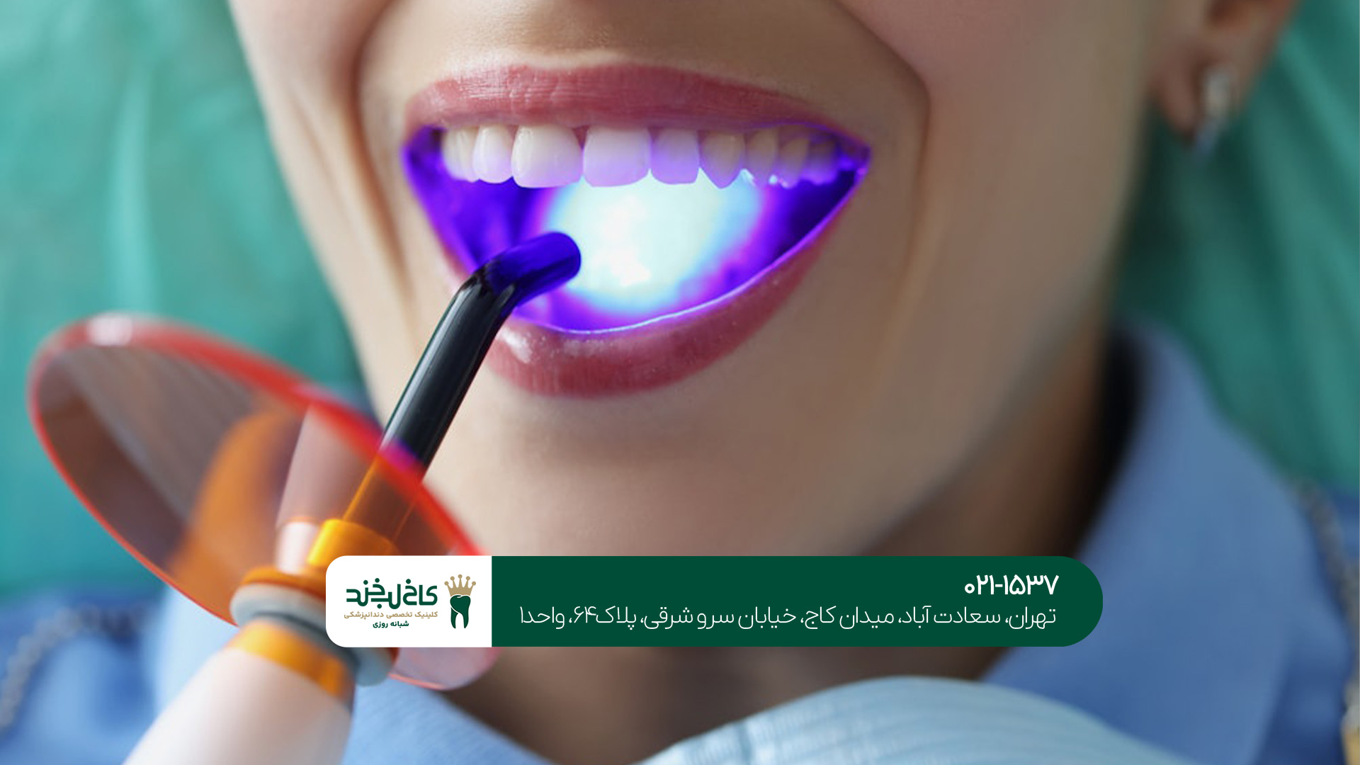 کامپوزیت دندان جنوب تهران کامپوزیت دندان جنوب تهران