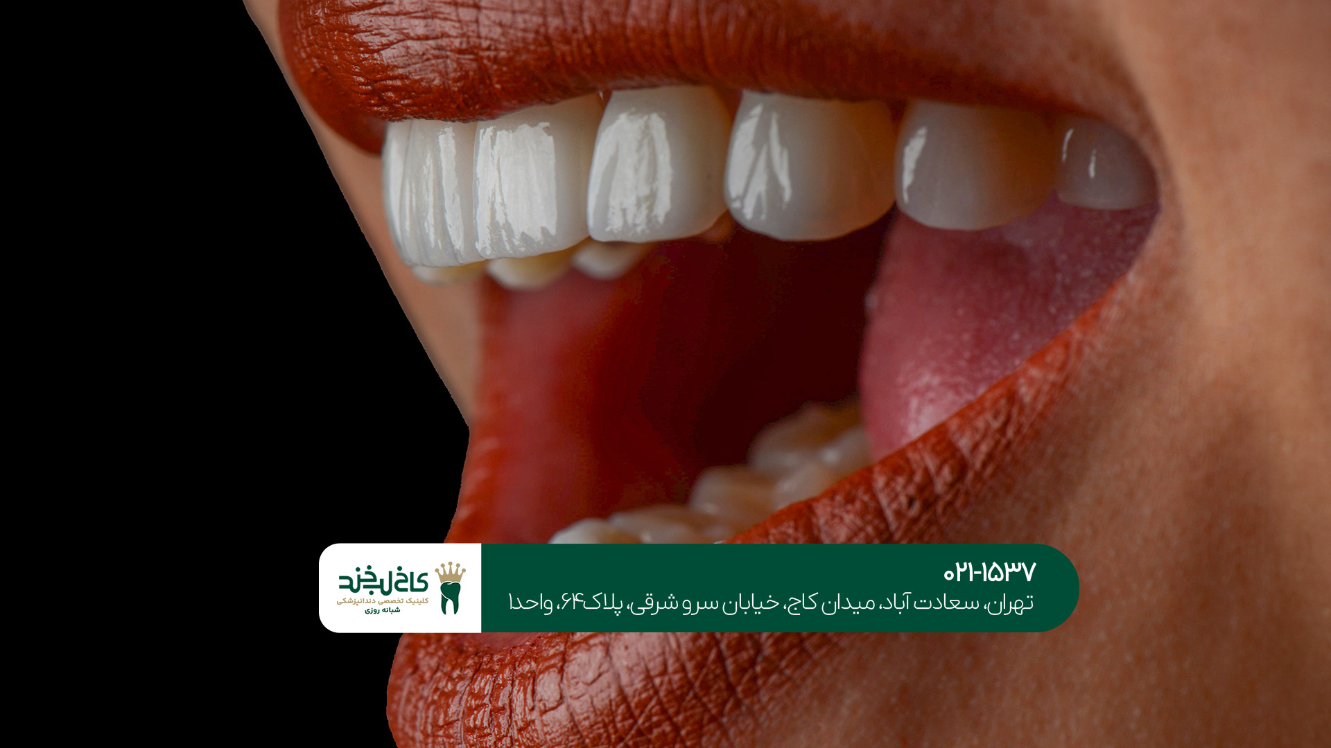 کامپوزیت تخصصی در دندانپزشکی زیبایی کامپوزیت تخصصی در دندانپزشکی زیبایی