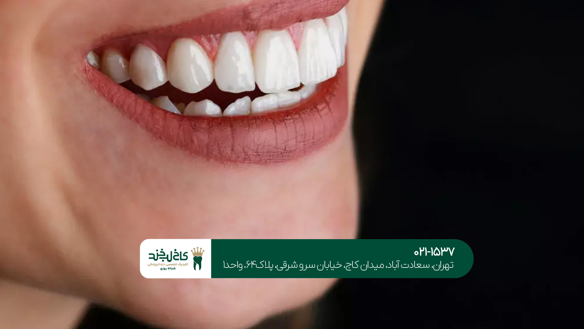 کامپوزیت تخصصی در دندانپزشکی زیبایی کامپوزیت تخصصی در دندانپزشکی زیبایی