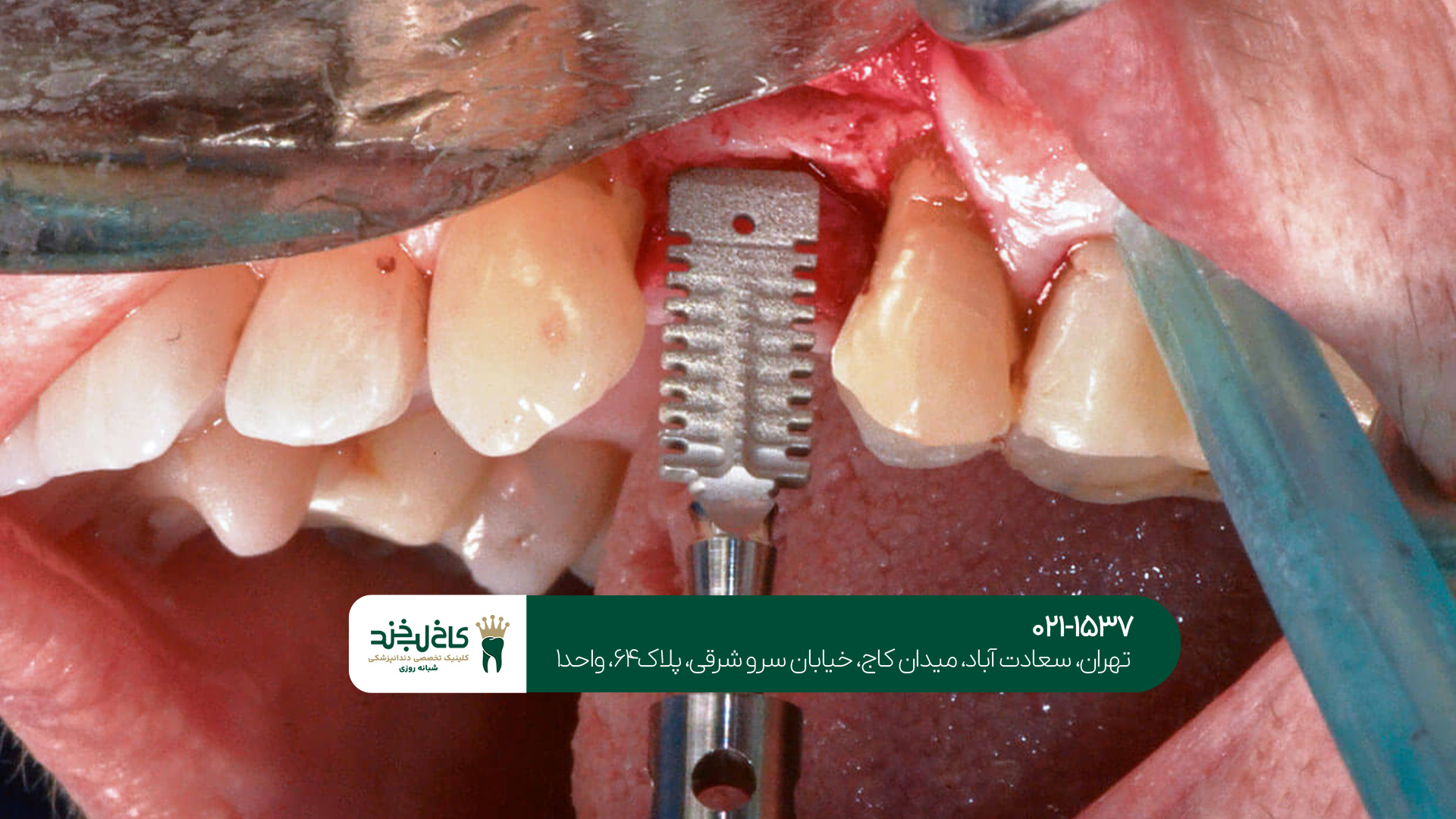 کلینیک ایمپلنت تهران کلینیک ایمپلنت تهران