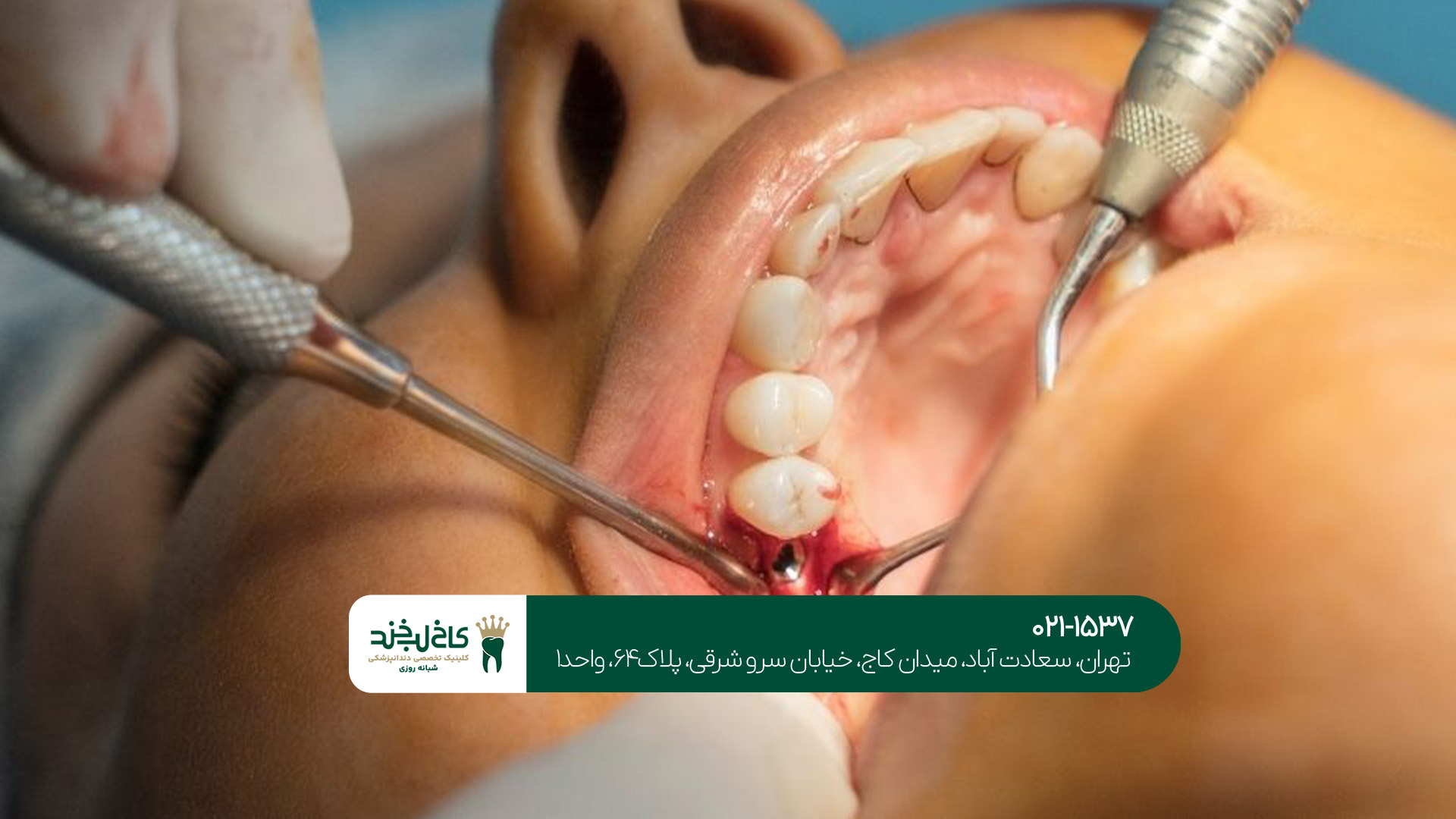 کلینیک ایمپلنت تهران کلینیک ایمپلنت تهران