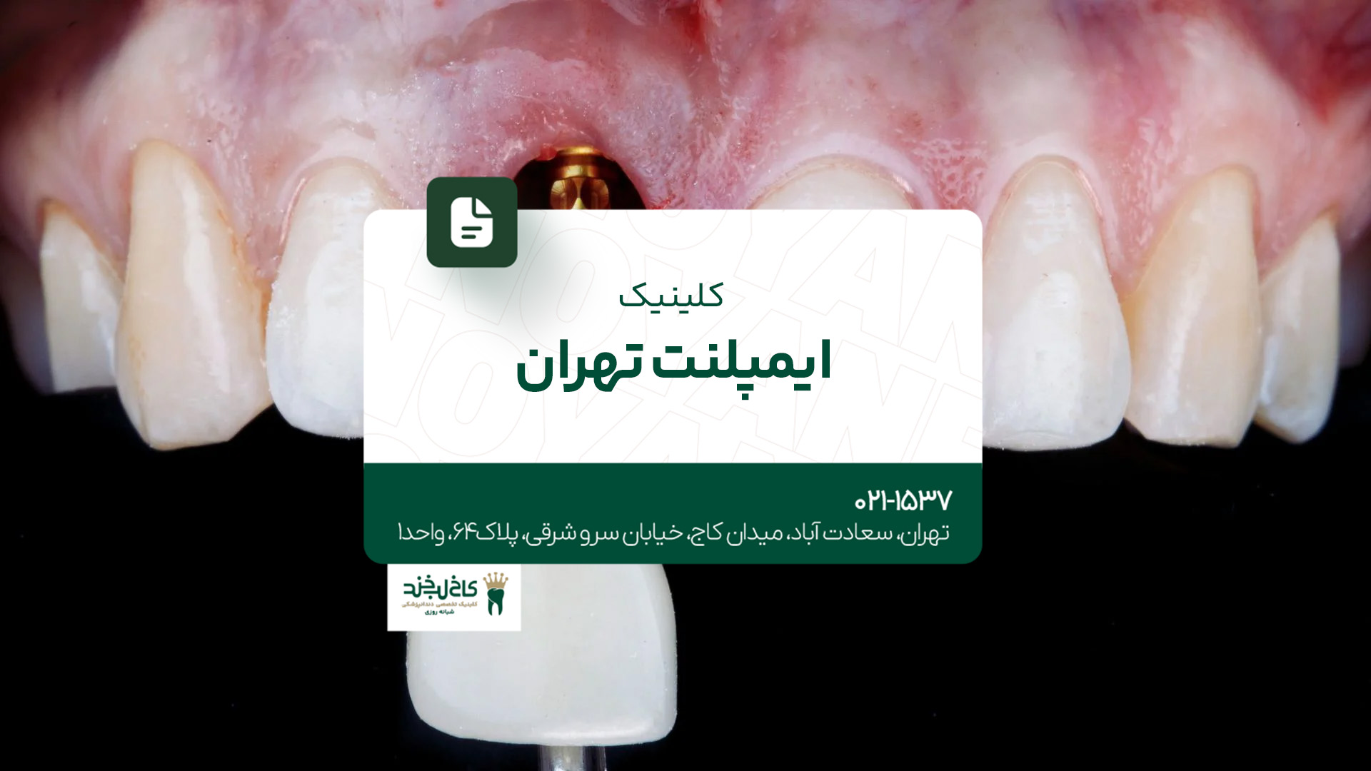 کلینیک ایمپلنت تهران کلینیک ایمپلنت تهران