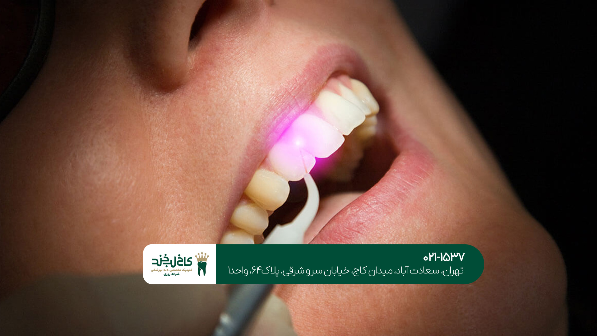 کلینیک تخصصی لمینت و کامپوزیت در تهران