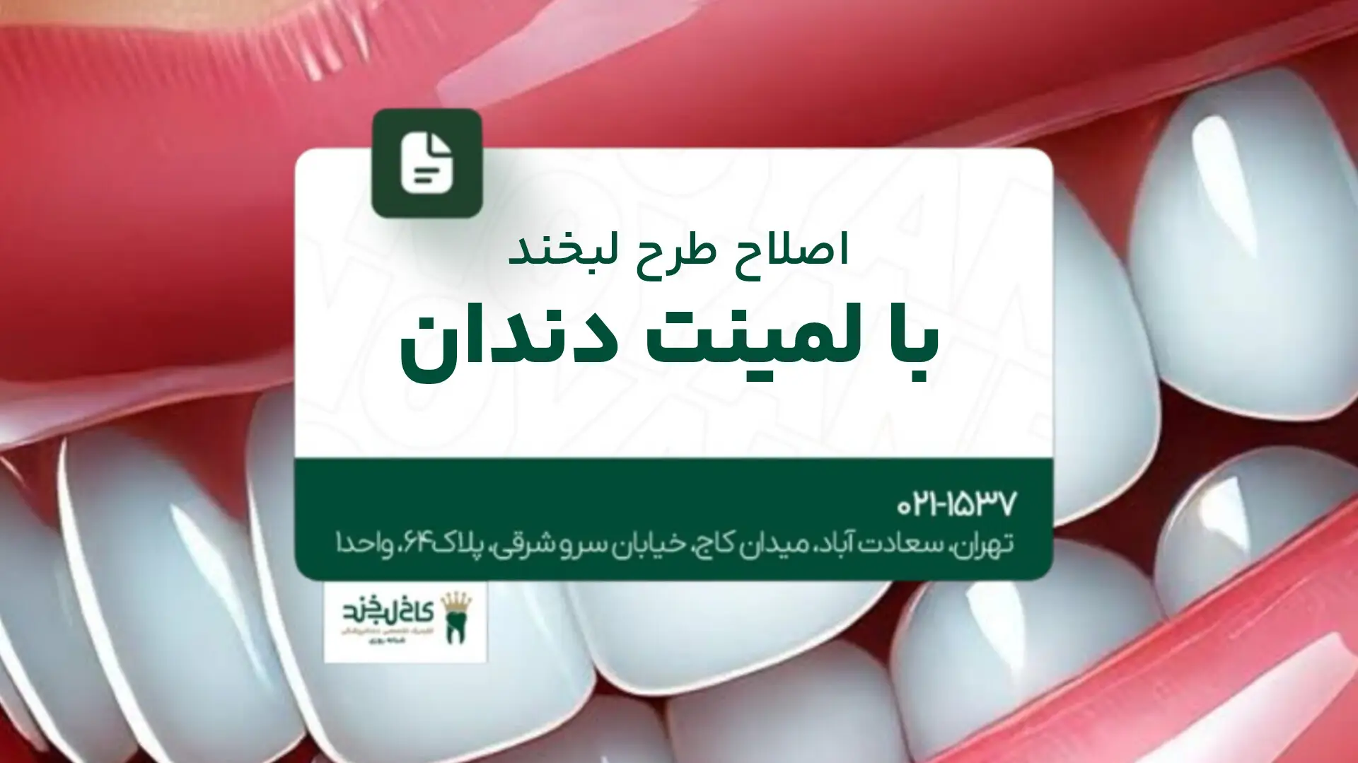 اصلاح طرح لبخند با لمینت دندان